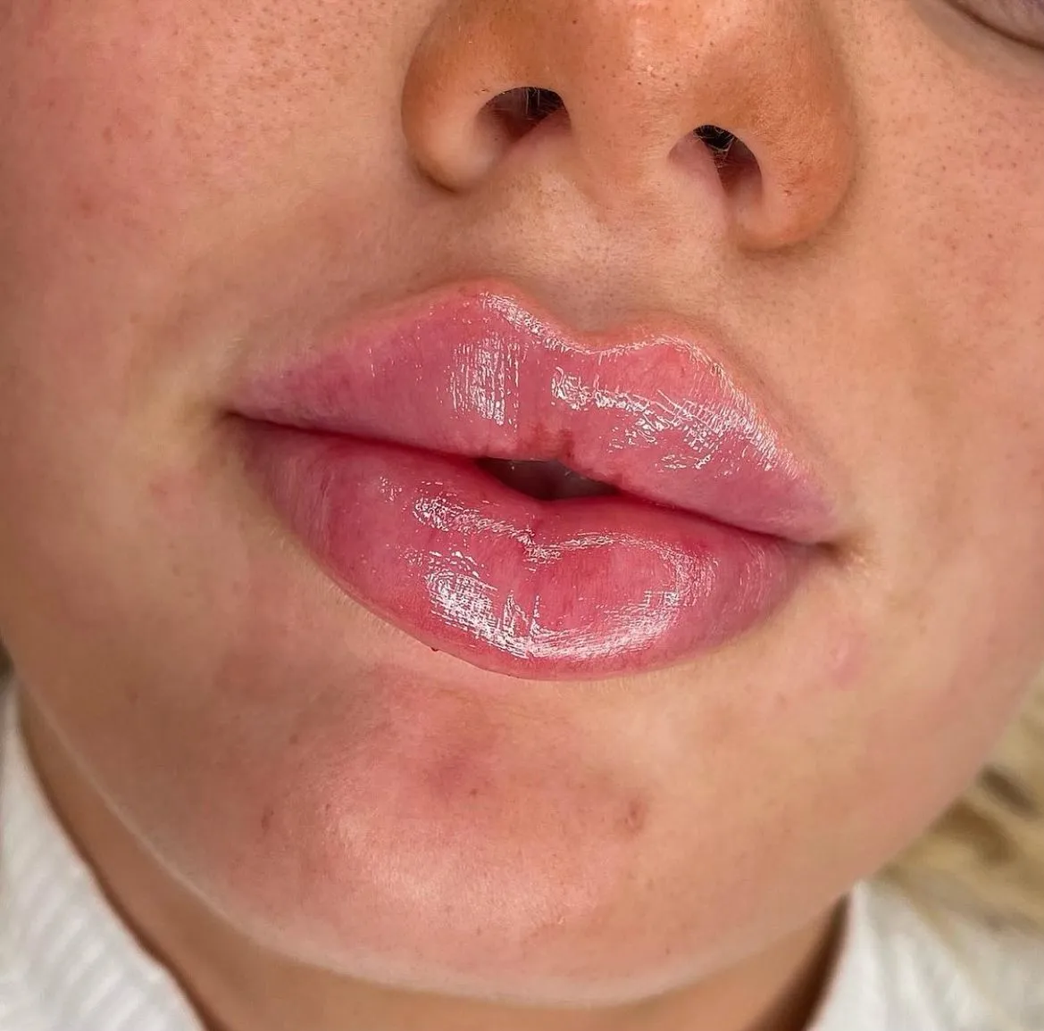 Fillers