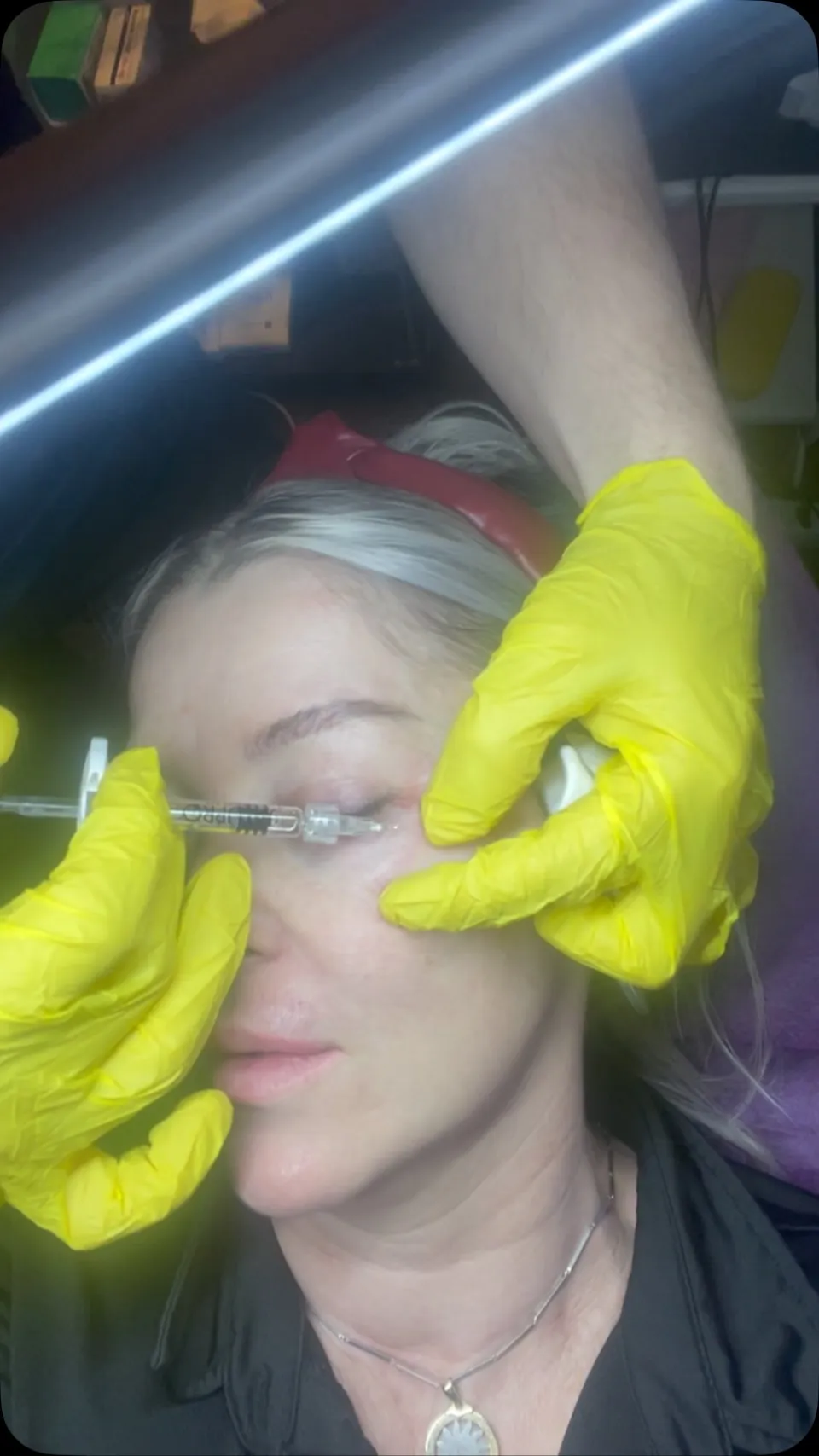 Botox
